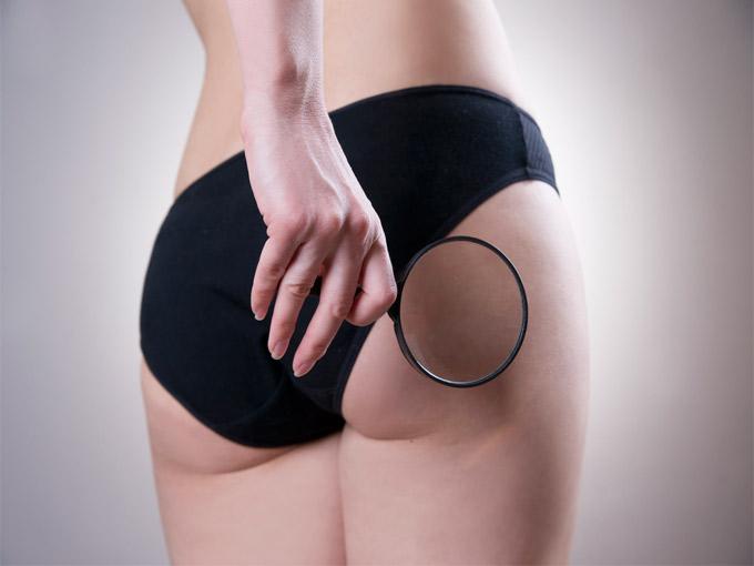 ¿Cómo eliminar la celulitis?