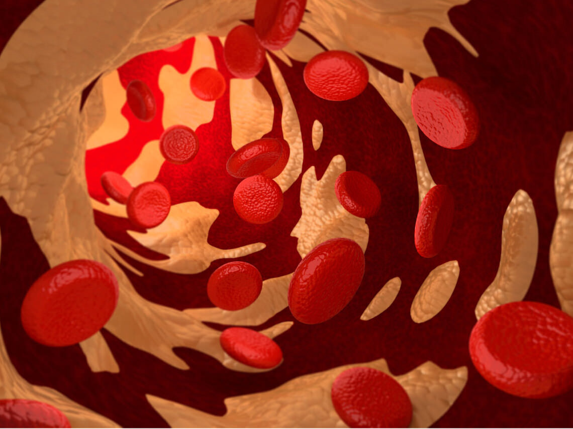 Colesterol LDL
