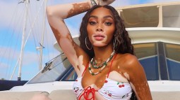 Vitiligo Winnie Harlow